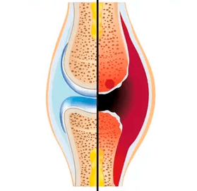 De structuur van een gezond en versleten gewricht met de aanduiding kraakbeenweefsel en gewrichtsvloeistof