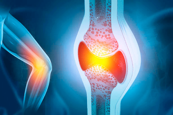 Preventie van gewrichtsziekten